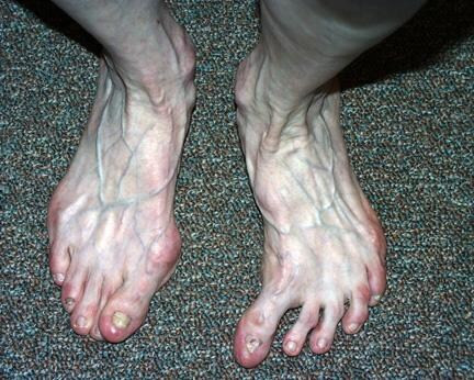 Hallux Varus